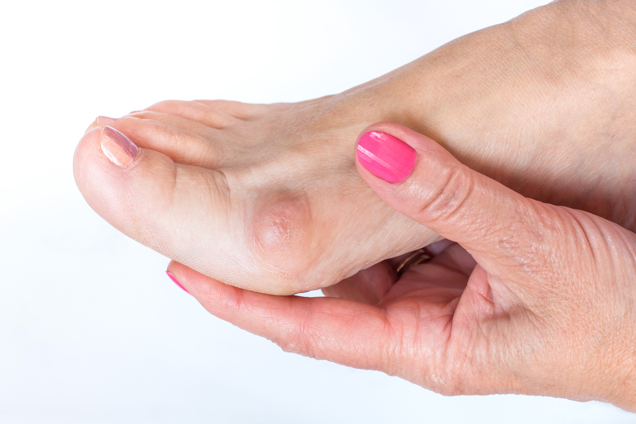 Early Treatment Can Halt Bunions From Worsening The Oldish 