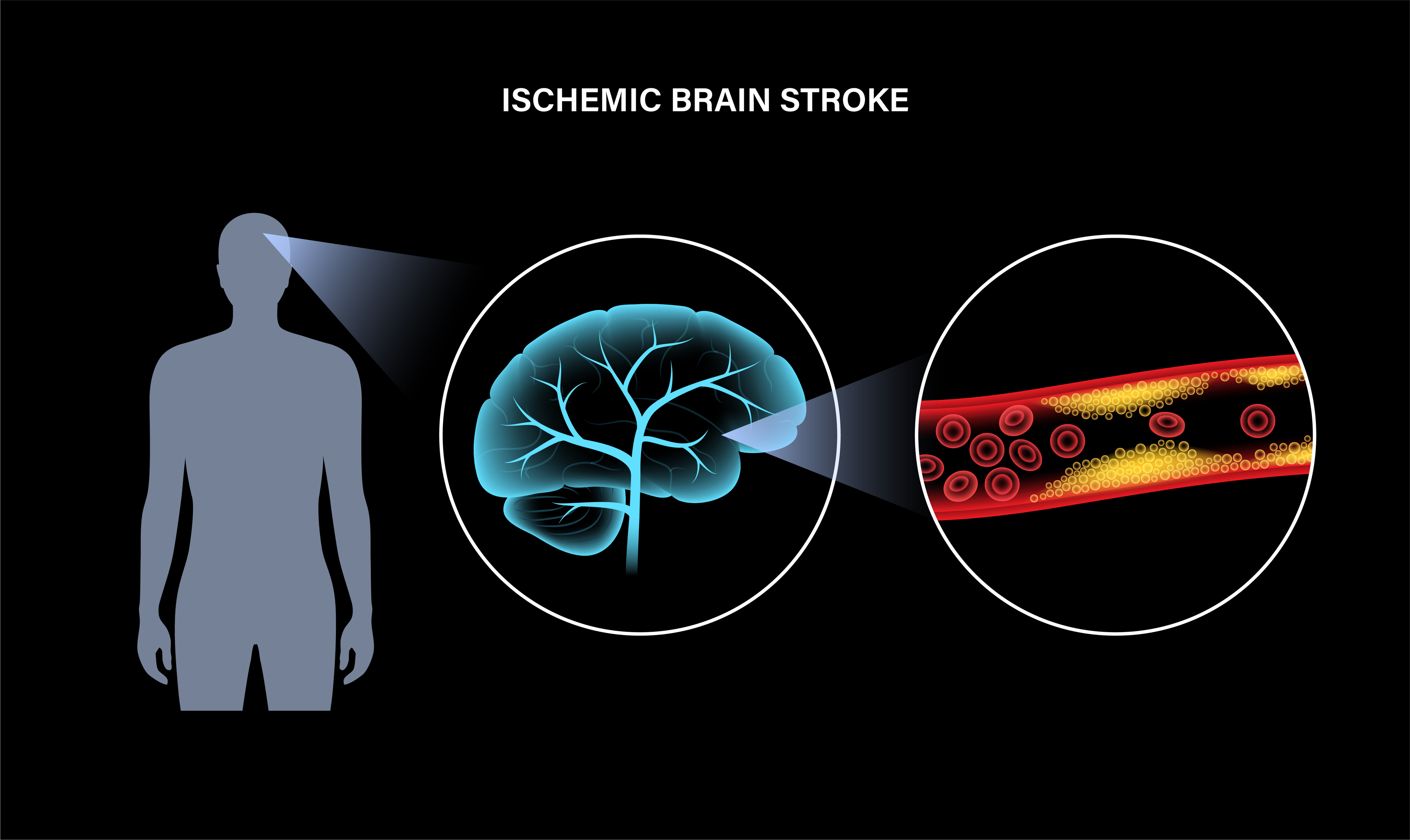 neurologists-ask-doctors-to-drop-the-term-tia-the-oldish