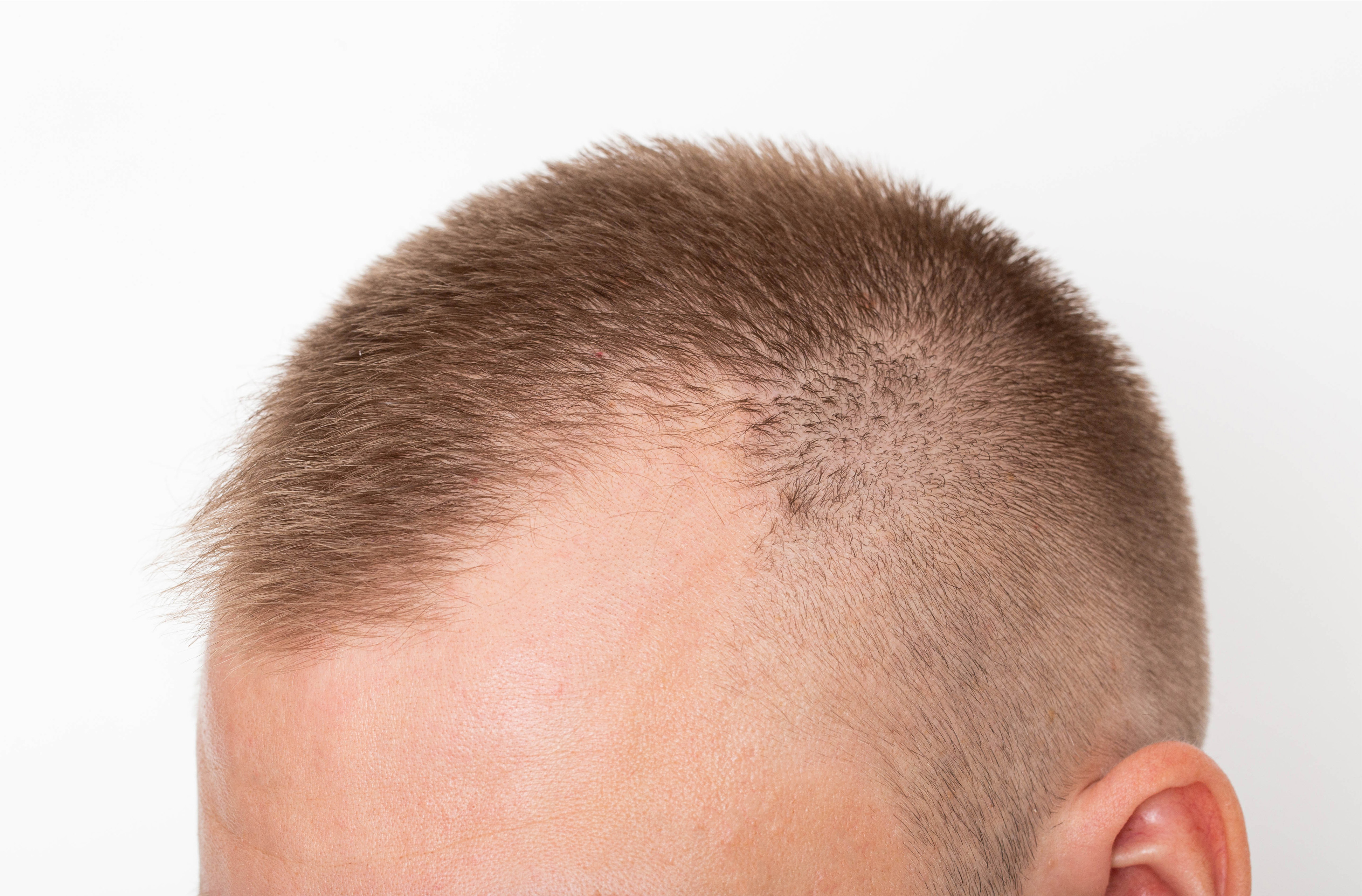 What Is a Hairline Tattoo  Precise Scalp Micro