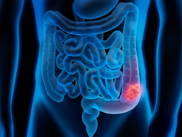 illustration of a polyp in the colorectal system